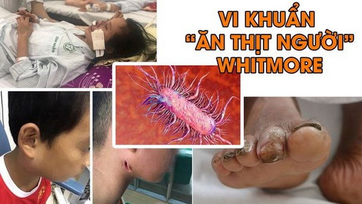 Quế Sơn phát hiện bệnh Whitmore-  hay còn gọi là "vi khuẩn ăn thịt người"